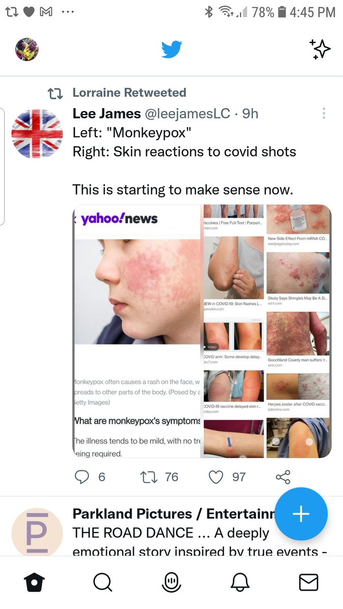 julesaf68's tweet photo. @Weeden3Sandra Uncle Bill wheels him out to pump out the fearporn to the gullible. He fails to see how foolish he looks promoting what we all know is vax induced #shingles . Shame on you @DrHilaryJones
#vaxsideeffects
#monkeypoxhoax https://t.co/kqD6384B57