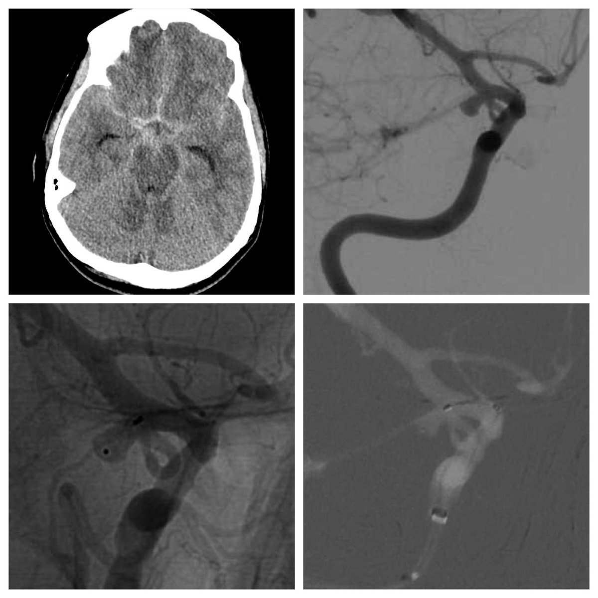 DavidAltschulMD's tweet image. #web for #ruptured #pcom #brain #aneurysm with large pcom arising from the neck. These cases used to be more challenging requiring complex endovascular or surgical clipping. Now life is easy web it #iloveneurosurgery #cerebrovascular #neuroendovascular