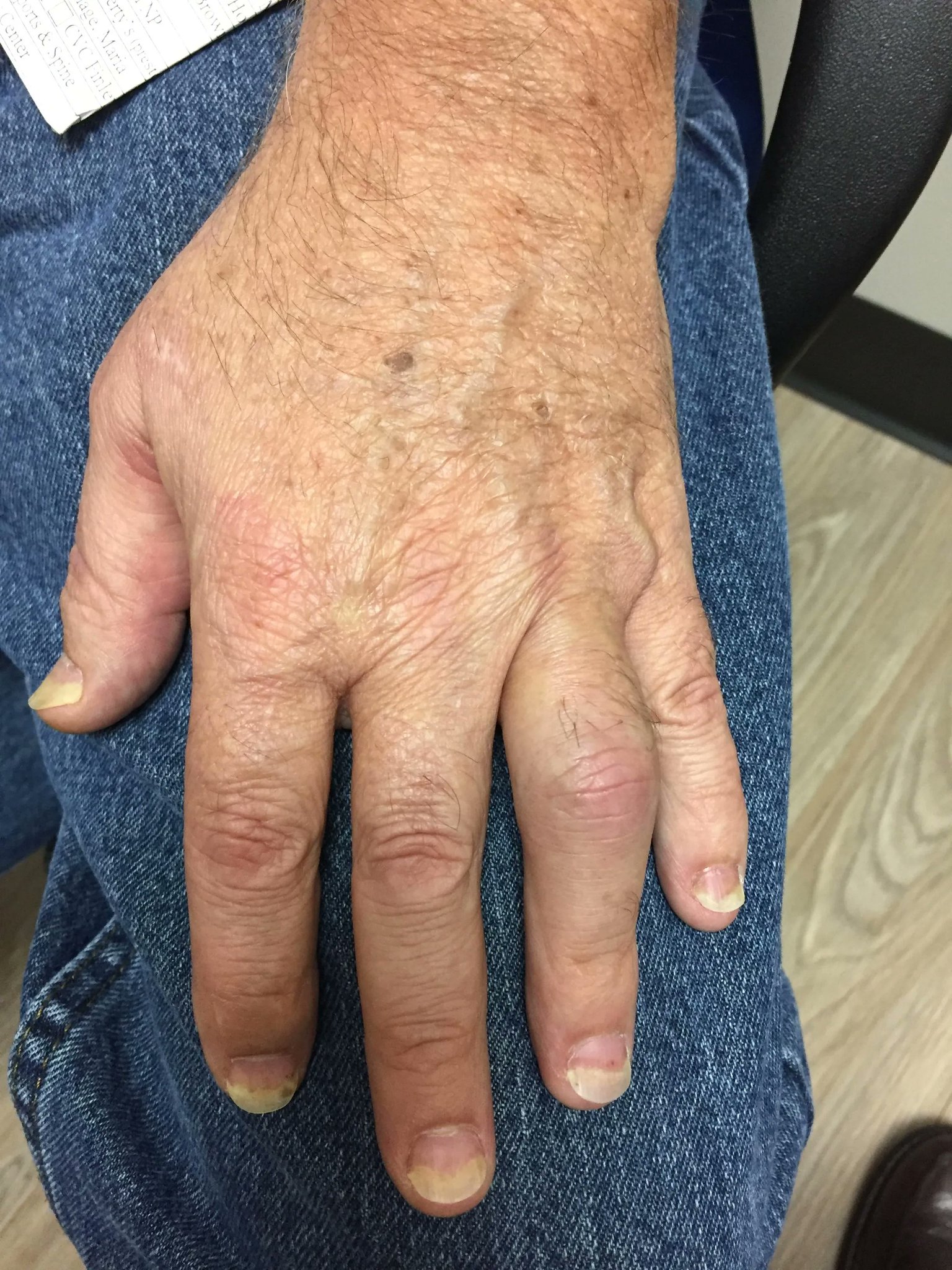 Dr. John Cush on Twitter "Biologic Persistence in Psoriatic Arthritis and Psoriasis Recent