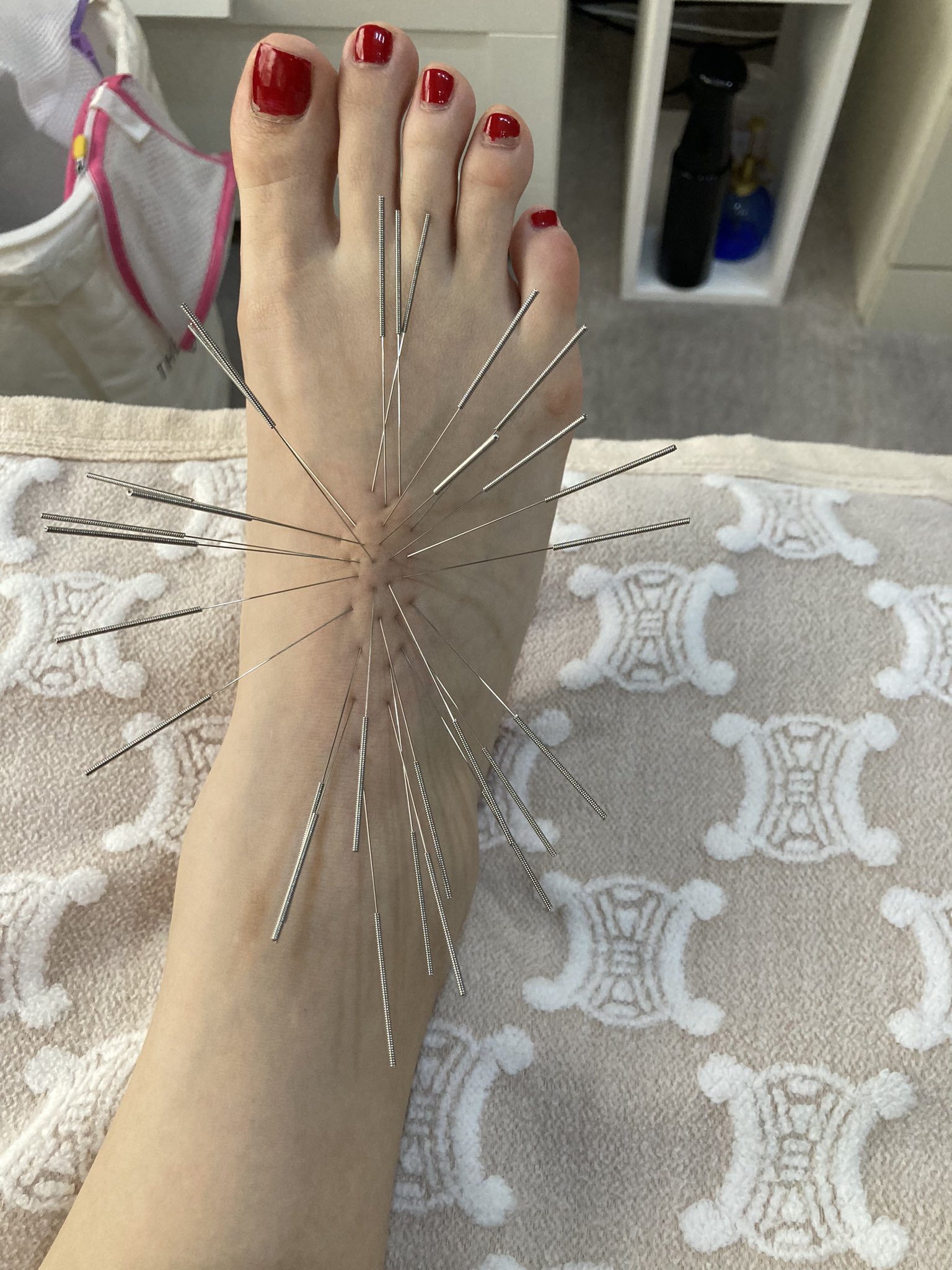 嶋田まり子 鍼処shirakawaなにわ院 正座したら痛いのよ コレ骨なんちゃうん と姉貴 大丈夫 コリのシワザだよ 足の甲にできたガングリオン ルート治療で撃退 ルート治療 ガングリオン T Co Bkxmcbswrc Twitter