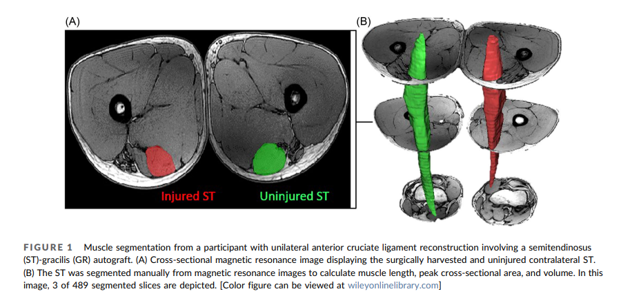 JOrthopRes's tweet photo. How does tendon harvest impact muscle shape? Check out this cross-sectional study investigating regional morphology differences in young adults after tendon harvest for #ACL reconstruction, utilizing #MRI, by @dumoulws and 
@DavidJohnSaxby1: https://t.co/rJZy48T7e9 https://t.co/QM2OYTS2M8