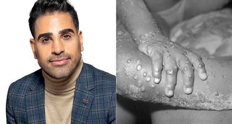 Monkeypox is not a 'gay disease' - but it is important to be aware of potential signs and symptoms.

<a href="/DrRanj/">Ranj Singh</a> cuts through the hysteria to deliver the facts on the recent spread of the virus.

Read now ➡️ buff.ly/39NqGS2