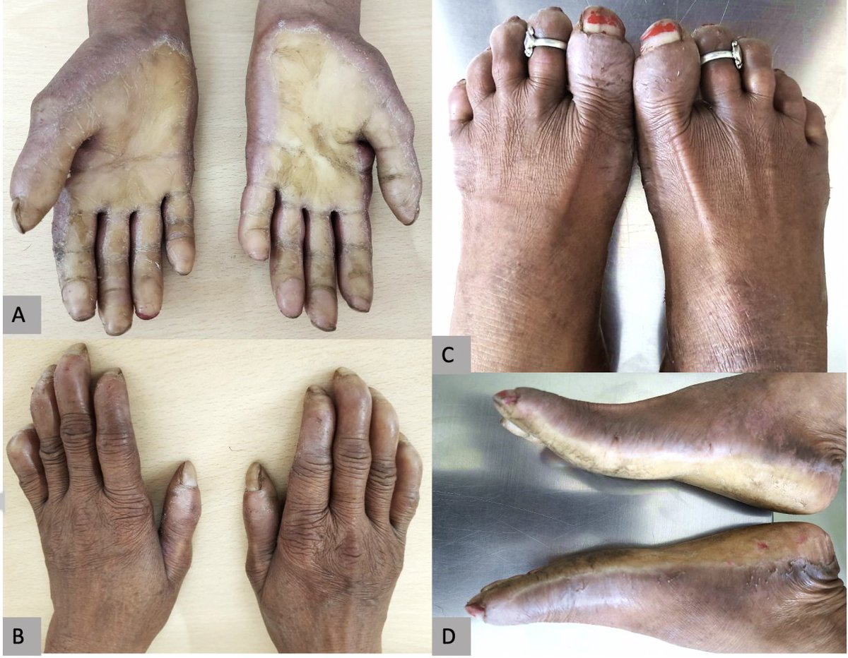 ERheumat's tweet photo. 🆒Scleroderma mimic
Any Guesses 🤔
https://t.co/Wv73EYRnhN https://t.co/rANUJm9il2