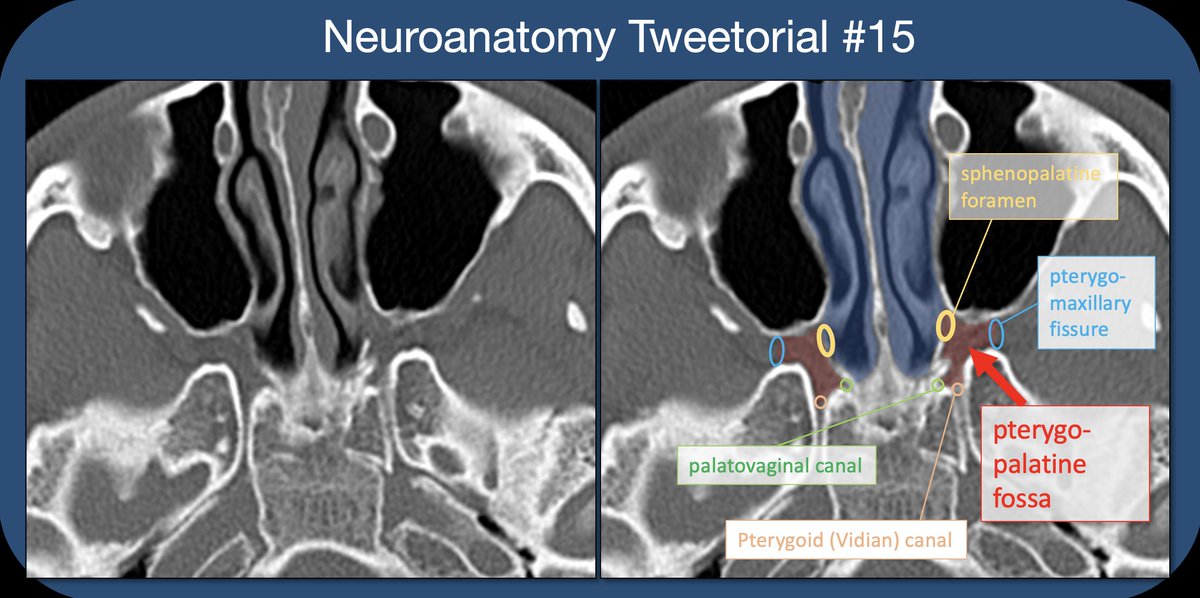 Pterygopalatine fossa🧵- inspired by ?s from med students in neuroanatomy lab & a resident w/ case of perineural tumor spread on same day! #meded #FOAMrad #medtwitter #medstudents #radiology #neurorad #HNrad #radres #neurology #ENT #temporalbone #neurosurgery #neuroanatomy
1/22