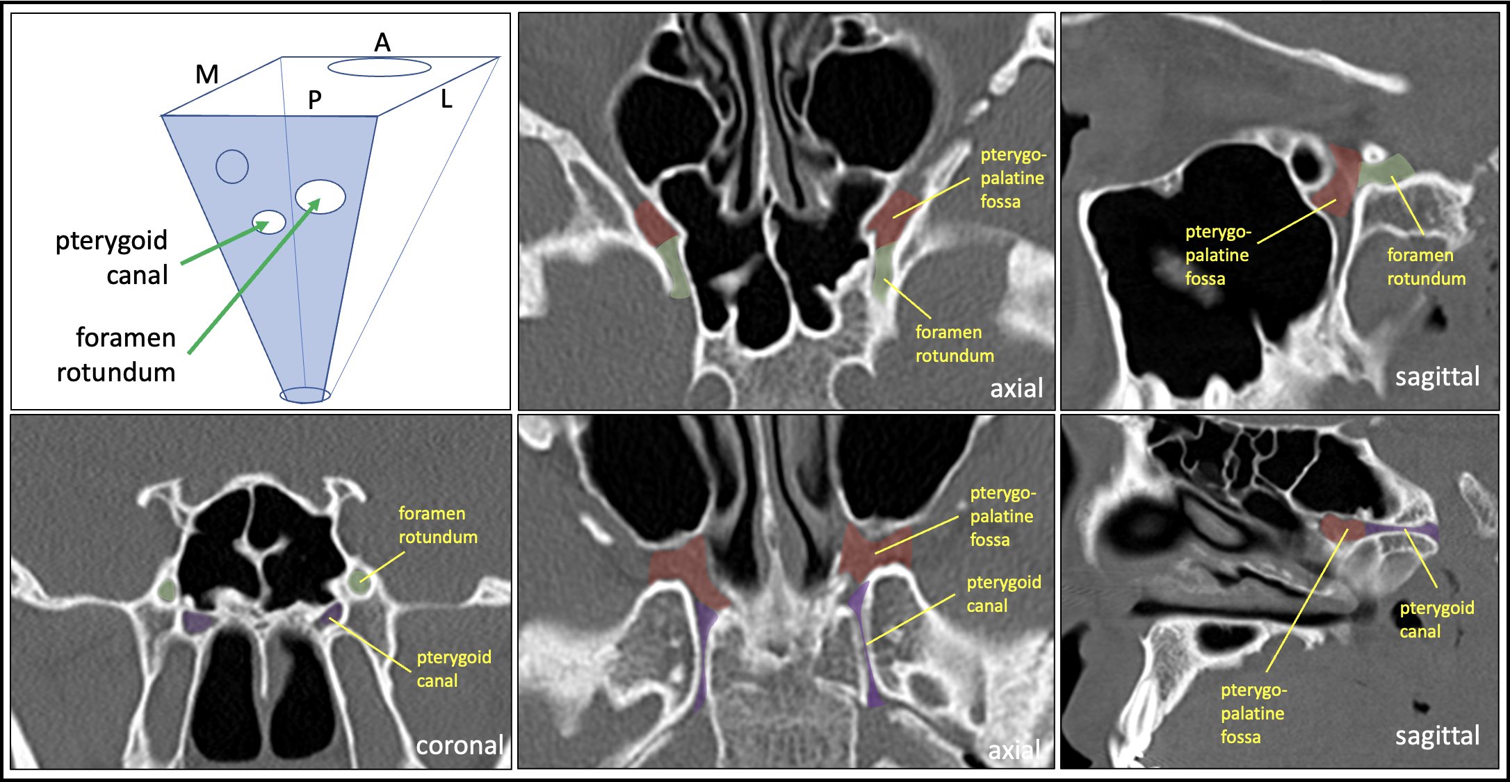 Aaron Rutman, MD on Twitter "The PTERYGOPALATINE FOSSA (PPF) is a