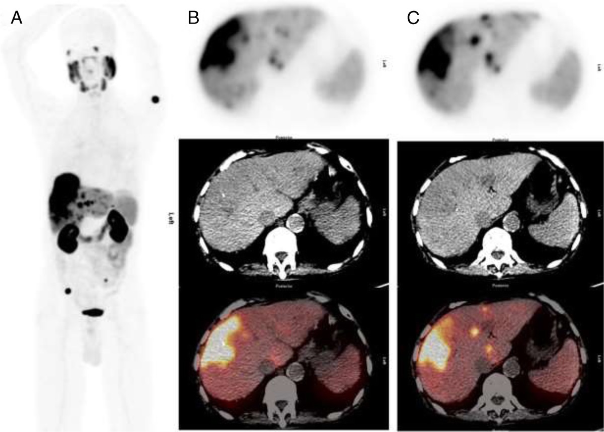 Current Issue: Occult Bone Metastases From Hepatocellular Carcinoma Detected on 68Ga-PMSA PET/CT dlvr.it/SQyRJ4