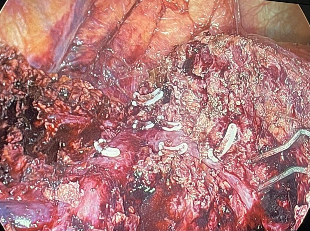 Scuola SIC di Chirurgia Epatica (@sicfegato) on Twitter photo <a href="/SICfegato/">Scuola SIC di Chirurgia Epatica</a> Bisegmentectomy S4a-8v for HCC. US, ICG and 3d reconstruction synergy!! <a href="/RussolilloNadia/">Nadia Russolillo</a> <a href="/Giammatwit/">Giammauro Berardi</a> <a href="/AP_FontanaMD/">andreafontanaMD</a> <a href="/SICfegato/">Scuola SIC di Chirurgia Epatica</a> Bisegmentectomy S4a-8v for HCC. US, ICG and 3d reconstruction synergy!! <a href="/RussolilloNadia/">Nadia Russolillo</a> <a href="/Giammatwit/">Giammauro Berardi</a> <a href="/AP_FontanaMD/">andreafontanaMD</a>