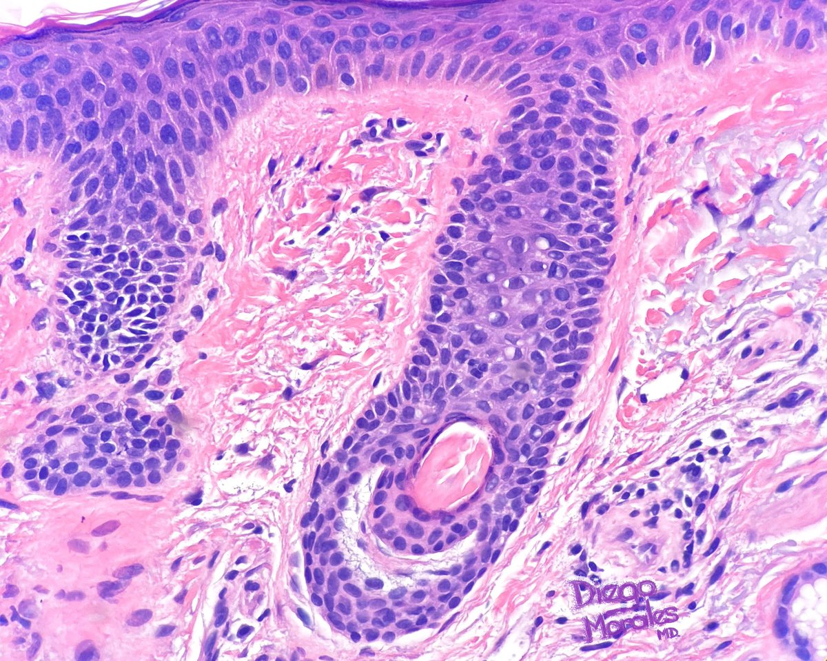 DiegoMoralesN's tweet photo. 14. Hair mantles can adopt different morphologic appearances depending on the orientation of the tissue, they also can exhibit varying degrees of sebaceous differentiation/lipidization.
Once you are aware, you’ll see them “everywhere”…
#pathfulness https://t.co/03uRI9l4oj