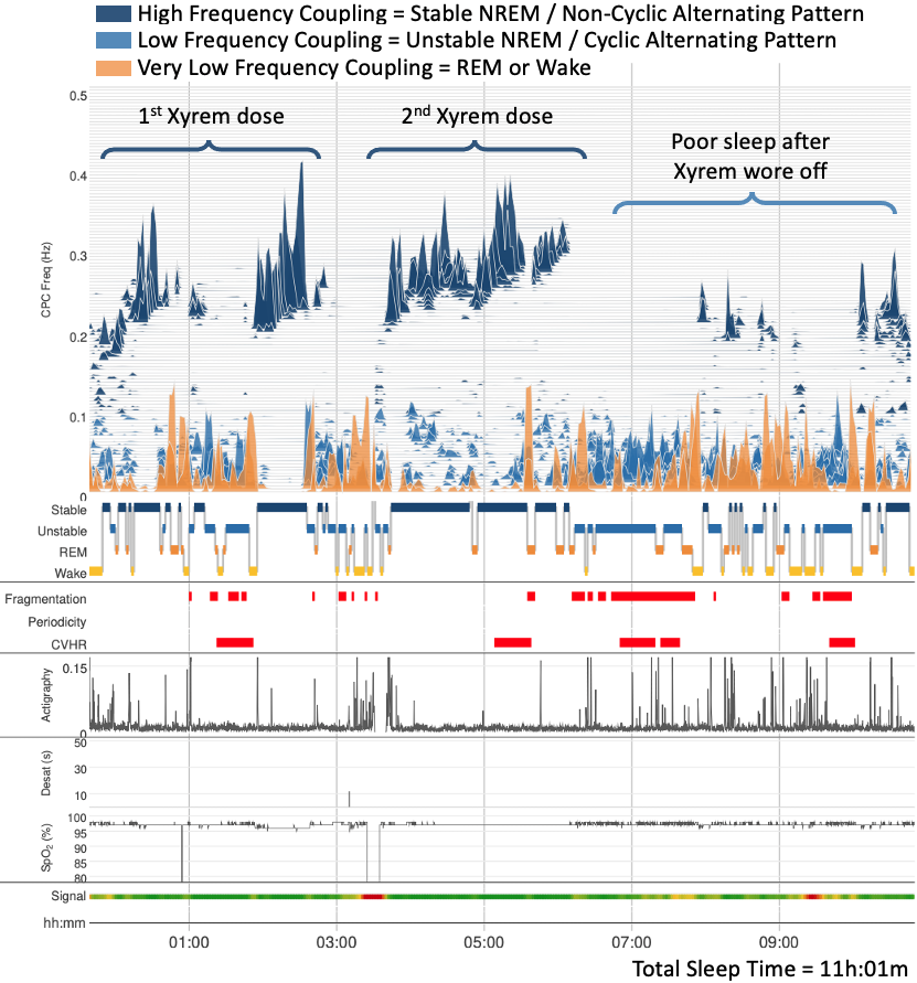 SleepyNeuroDoc's tweet photo. Objective portrait of #Xyrem on sleep quality in Idiopathic Hypersomnia patient with cardiopulmonary coupling. Spectrogram: 2 blocks of stable NREM (dark blue) from 2 Xyrem doses. After Xyrem wore off, rest of the night show poor sleep. TST = 11hr. No sleep apnea detected. #CPC https://t.co/490MG50cah