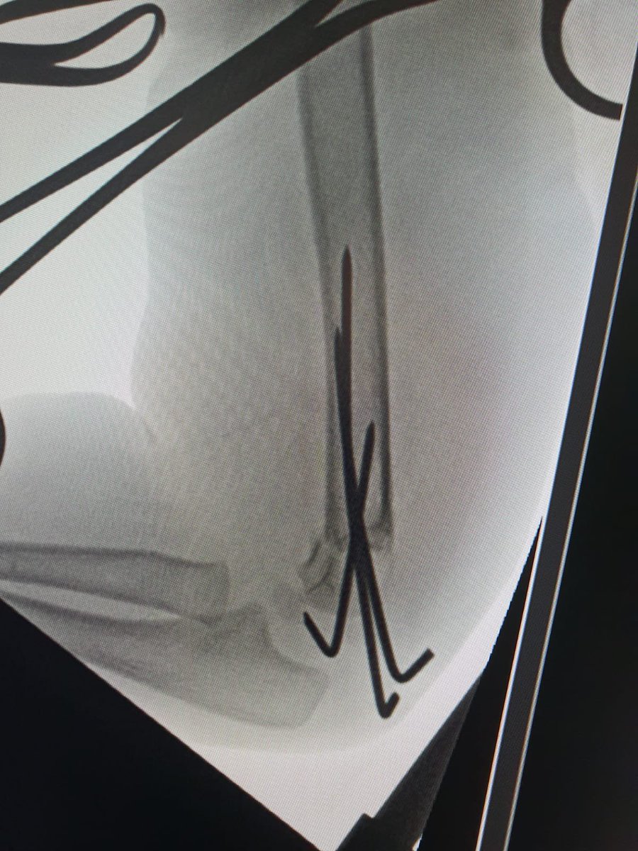 Post Graduate Institute of Child Health, Noida (@pgichildhealth) on Twitter photo True Emergency Trauma Case: Pink Pulse less Hand- No Radial Pulse- 2.5 year male child fell from swing late in evening and injured left elbow. On presentation was able to move his fingers (no neurological deficit).<a href="/IasAlok/">Alok Kumar 🇮🇳</a> <a href="/as29762/">Ajai Singh</a> <a href="/kgmu_medical/">KING GEORGE MEDICAL UNIVERSITY, LUCKNOW, UP, INDIA</a> <a href="/mededuup/">Medical Education UP</a> <a href="/brajeshpathakup/">Brajesh Pathak</a> True Emergency Trauma Case: Pink Pulse less Hand- No Radial Pulse- 2.5 year male child fell from swing late in evening and injured left elbow. On presentation was able to move his fingers (no neurological deficit).<a href="/IasAlok/">Alok Kumar 🇮🇳</a> <a href="/as29762/">Ajai Singh</a> <a href="/kgmu_medical/">KING GEORGE MEDICAL UNIVERSITY, LUCKNOW, UP, INDIA</a> <a href="/mededuup/">Medical Education UP</a> <a href="/brajeshpathakup/">Brajesh Pathak</a>