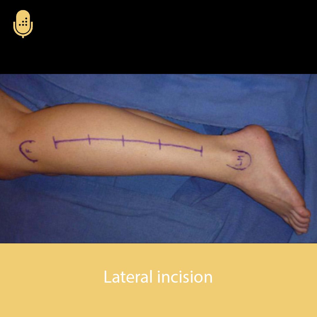 Orthobullets on Twitter "Leg Compartment Syndrome is a devastating