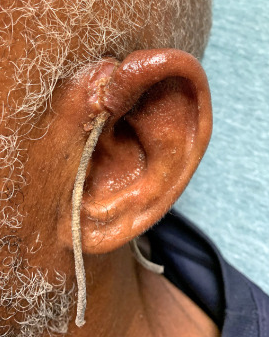 jem_journal's tweet image. JEM Case of the Week:  56 yo M presents with bilateral ear pain x 2-3 weeks.  On exam you find this.  What are your next steps? Answer posted Thursday  #COVID19 #Pandemicproblems #medtwitter @aaeminfo