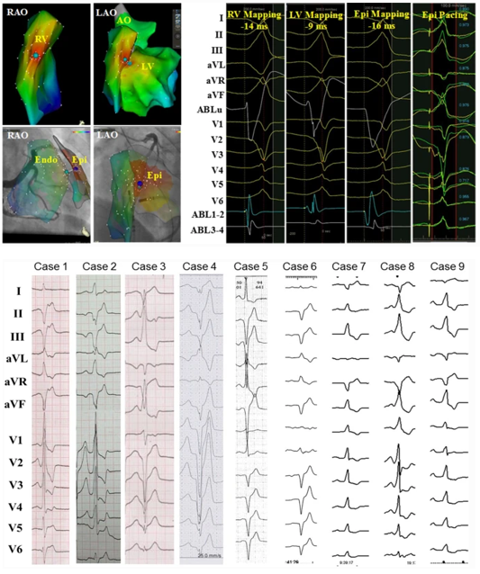 JICE_EP's tweet photo. Hot off the press @JICE_EP #Freeread

Authors report results of epicardial abl of idiopathic VAs after failed endo-abl from sites origin remote to LV summit, Crux, coronary venous system
Free link: https://t.co/l5kfIsbiAu

#EPeeps
@JRWinterfield @Jackson_J_Liang
@andresenriqueza https://t.co/L2hdRXpfs1