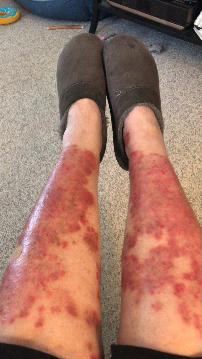 psoriasisexp's tweet photo. My legs are on fire. How do you keep from scratching the dry skin off and making them raw
#psoriasisproblems #psoriasissucks #psoriasislife #psoriasisinspiration #psoriasis #psoriasiswarrior #psoriasisawareness #psoriasisgirl #autoimmunedisease #guttatepsoriasis https://t.co/r1OP1GL059
