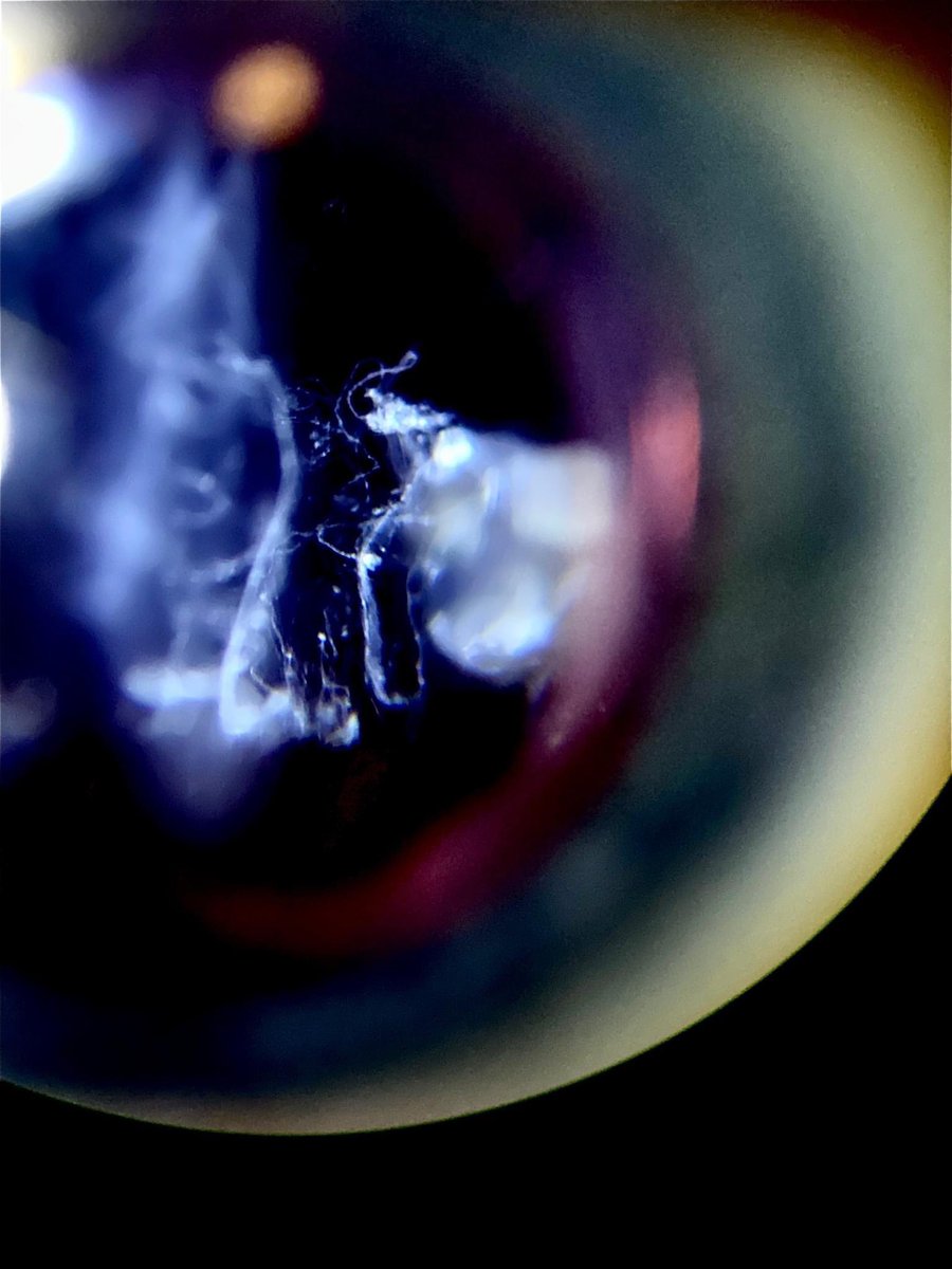 Incredible view of vitreous floaters. Although they can look like art when viewing them, they can significantly reduce quality of vision and negatively effect quality of life. Whether laser or surgery, ignoring them is not always the best option 🙂.
#floaters #vitreous