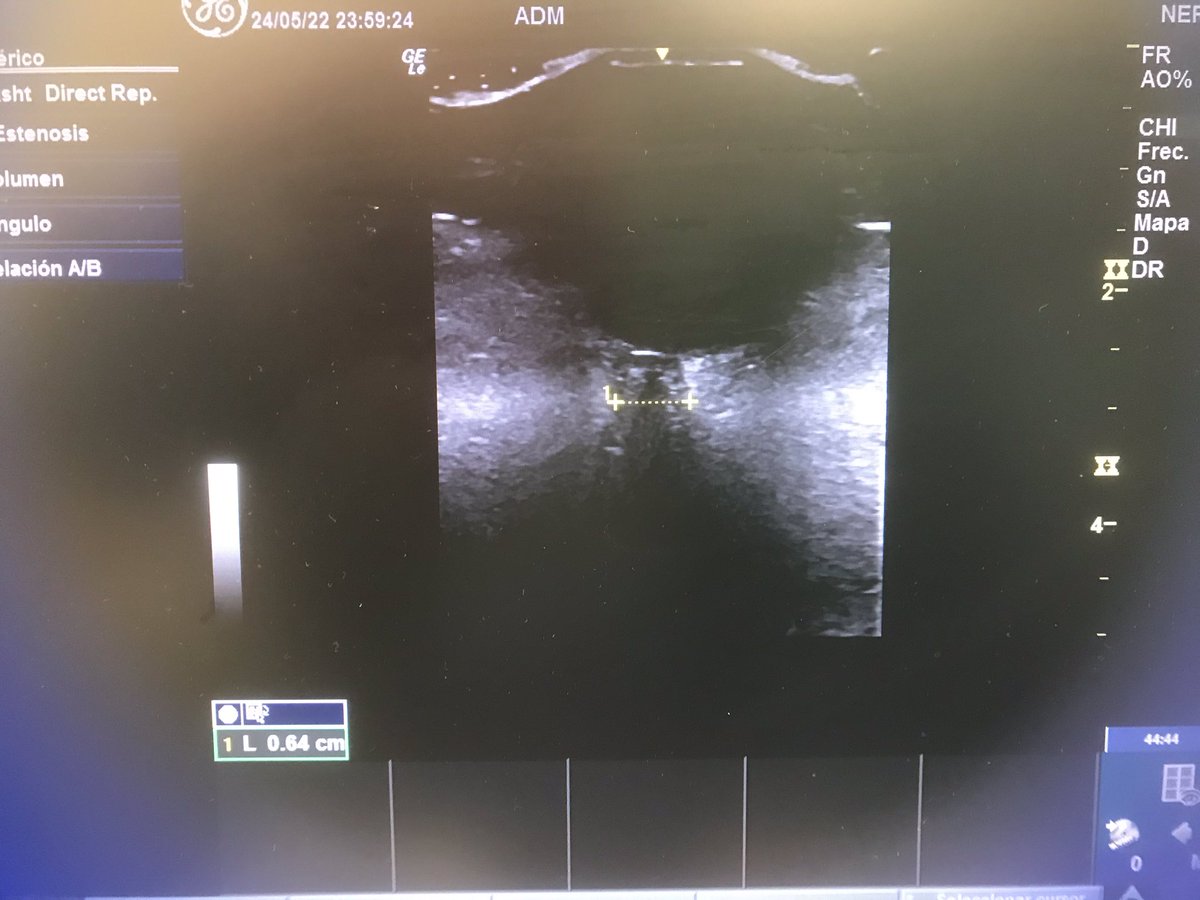 ResisAnCHUS's tweet photo. 😊#POCUS
😊#POCUS
😊#POCUS
🧒🏻Being taught by your junior #Anesthesia mates challenges that boundaries...🙌🙌🙌 #opticnerveultrasound #PPereiraArgiz @AlvarezAnest @AndreaCalvoRey1 @GloriaPrada13 #PDoldan #EFerreiroa @AlbertoBolon #CValdés @bcm2012 @POCUS_Society @sedar_es https://t.co/O5HS4KnoWm