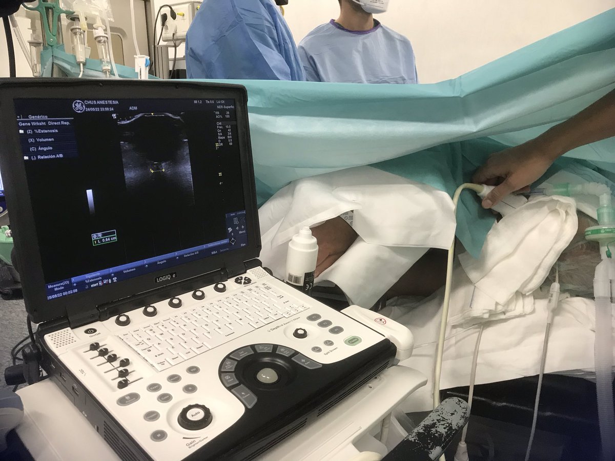 ResisAnCHUS's tweet photo. 😊#POCUS
😊#POCUS
😊#POCUS
🧒🏻Being taught by your junior #Anesthesia mates challenges that boundaries...🙌🙌🙌 #opticnerveultrasound #PPereiraArgiz @AlvarezAnest @AndreaCalvoRey1 @GloriaPrada13 #PDoldan #EFerreiroa @AlbertoBolon #CValdés @bcm2012 @POCUS_Society @sedar_es https://t.co/O5HS4KnoWm