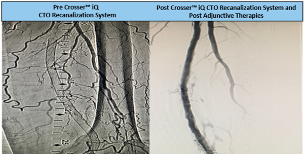 TimHugBD's tweet photo. Mid-moderately calcified distal peroneal lesion w/ 20cm CTO. Dr. Cawich used #CrosseriQ catheter & observed a 1 min 15 sec activation time to cross. #CrossThisFast
For use in peripheral artery CTOs; Not for use in carotid arteries. Safety info: https://t.co/y7EIvm1Q66 https://t.co/fFbIlBO7KJ