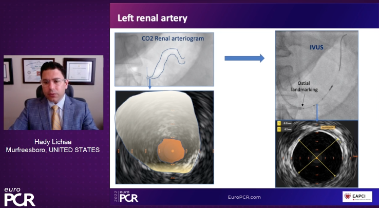 HadyLichaaMD's tweet photo. #R2R: #Radial2Renal presented @ #EuroPCR2022
Novel term & particularly favorable #RadialFirst access
#IVUSfirst + #CO2angio -> ⬇️dye
@EricSecemskyMD @mirvatalasnag @prkothapalli @jcgeorgemd @agtruesdell @kerrigjl @adityadoc1 @RajTayalMD @mcbunte @sealtin1 @AkramWIbrahim https://t.co/bnn9lE52h8