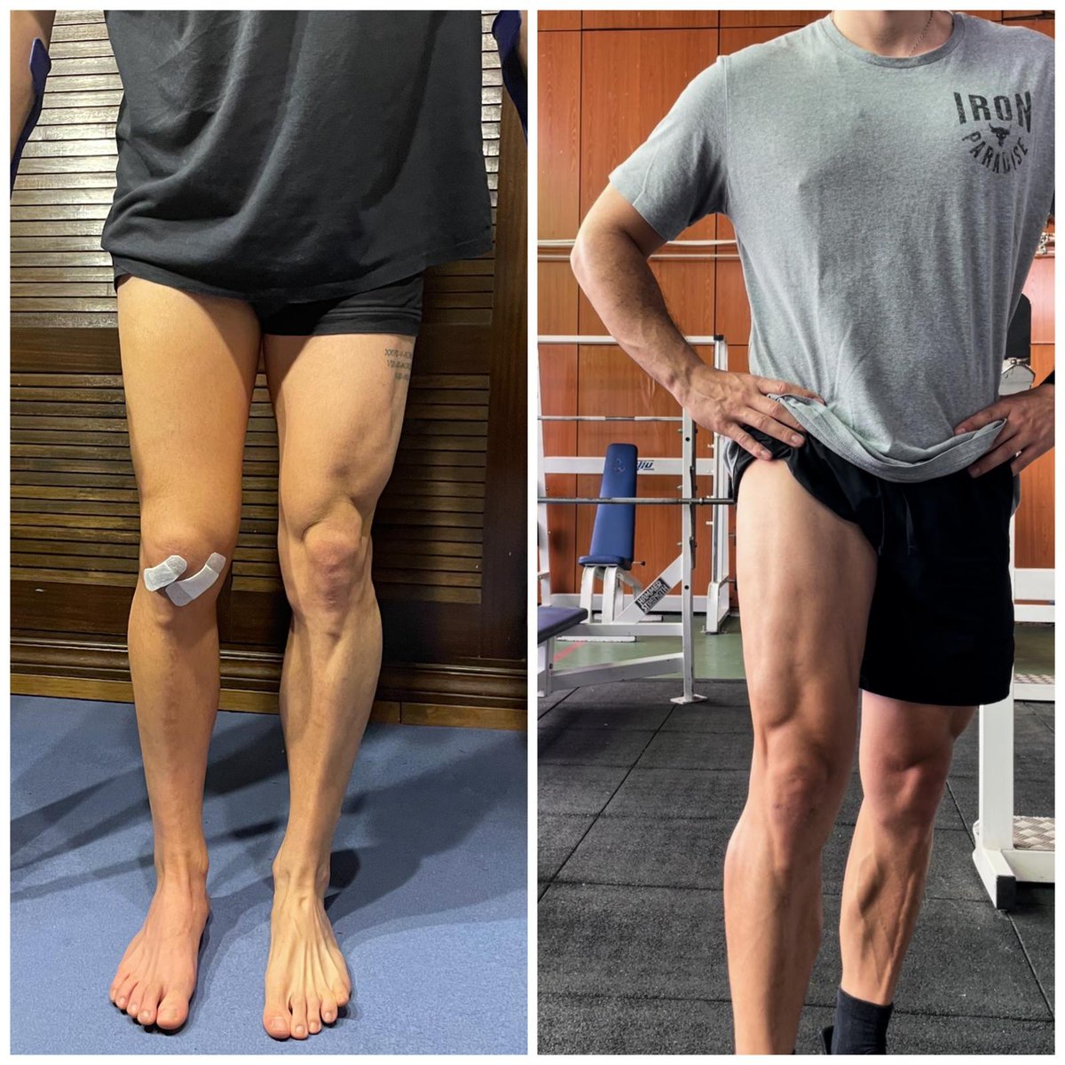 Pacientes contentos, equipo contento.

Evolución de paciente operado por rotura compleja de #menisco externo.

Nos alegramos de que esté al 100% para preparar la oposición y seguir disfrutando del #deporte

#Readaptación #Fisioterapia
#ReturnToPlay
#RTP #Rodilla #BoadillaDelMonte