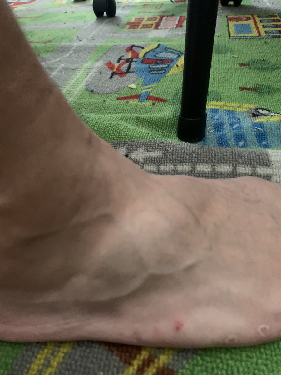 Era_DIC's tweet photo. @and1basketball This is CRAZY And1 Lol i wore this shoe less than 10x &amp; it just ripped from V to A. Wore for Basketball like 3x and a handful of times regularly. What in the hell. $20 at walmart is too expensive for this. My ankle is fat as hell! Picture dont even do it justice. https://t.co/2XtHsQhN8z
