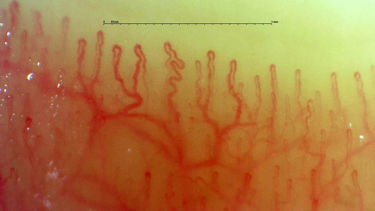 gmaldonadovelez's tweet photo. G-scope trials continues ✨
Amazing pictures and analysis coming up 🚨
#RheumTwitter #MedTwitter #Capillaroscopy #GScope #CapillaryIo #NailfoldCapillaroscopy https://t.co/k4S9spi503