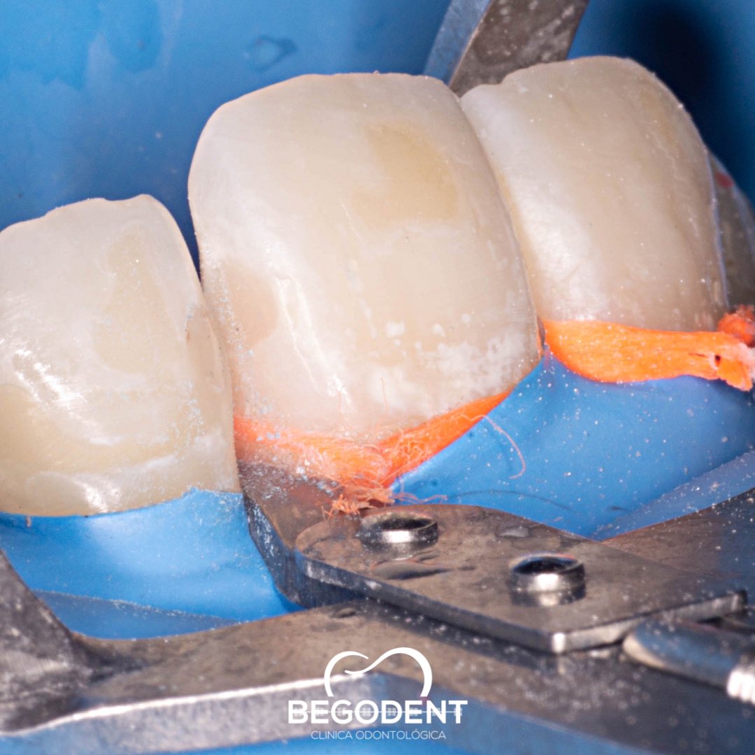 RodolfoBerrueto's tweet photo. Restauración de Lesión cariosa Clase III con ayuda del separador tipo ivory de @caballerodental
¿Porque hacer más si podemos hacer menos?
.
.
#begodent #biomimeticdentistry #odontologia #minimaldentistry #minimainvasion https://t.co/cRvOLn0YZy
