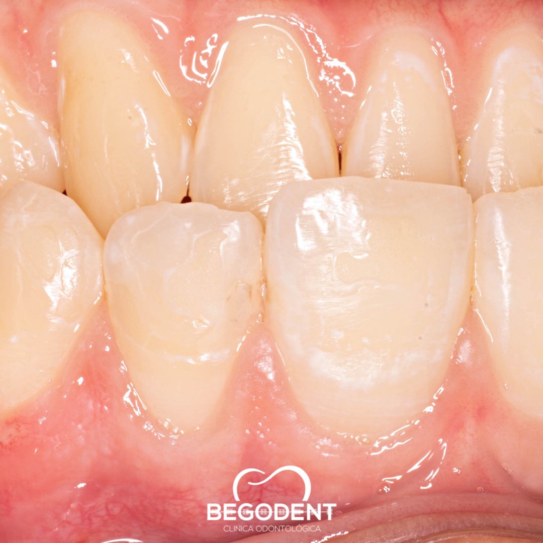 RodolfoBerrueto's tweet photo. Restauración de Lesión cariosa Clase III con ayuda del separador tipo ivory de @caballerodental
¿Porque hacer más si podemos hacer menos?
.
.
#begodent #biomimeticdentistry #odontologia #minimaldentistry #minimainvasion https://t.co/cRvOLn0YZy