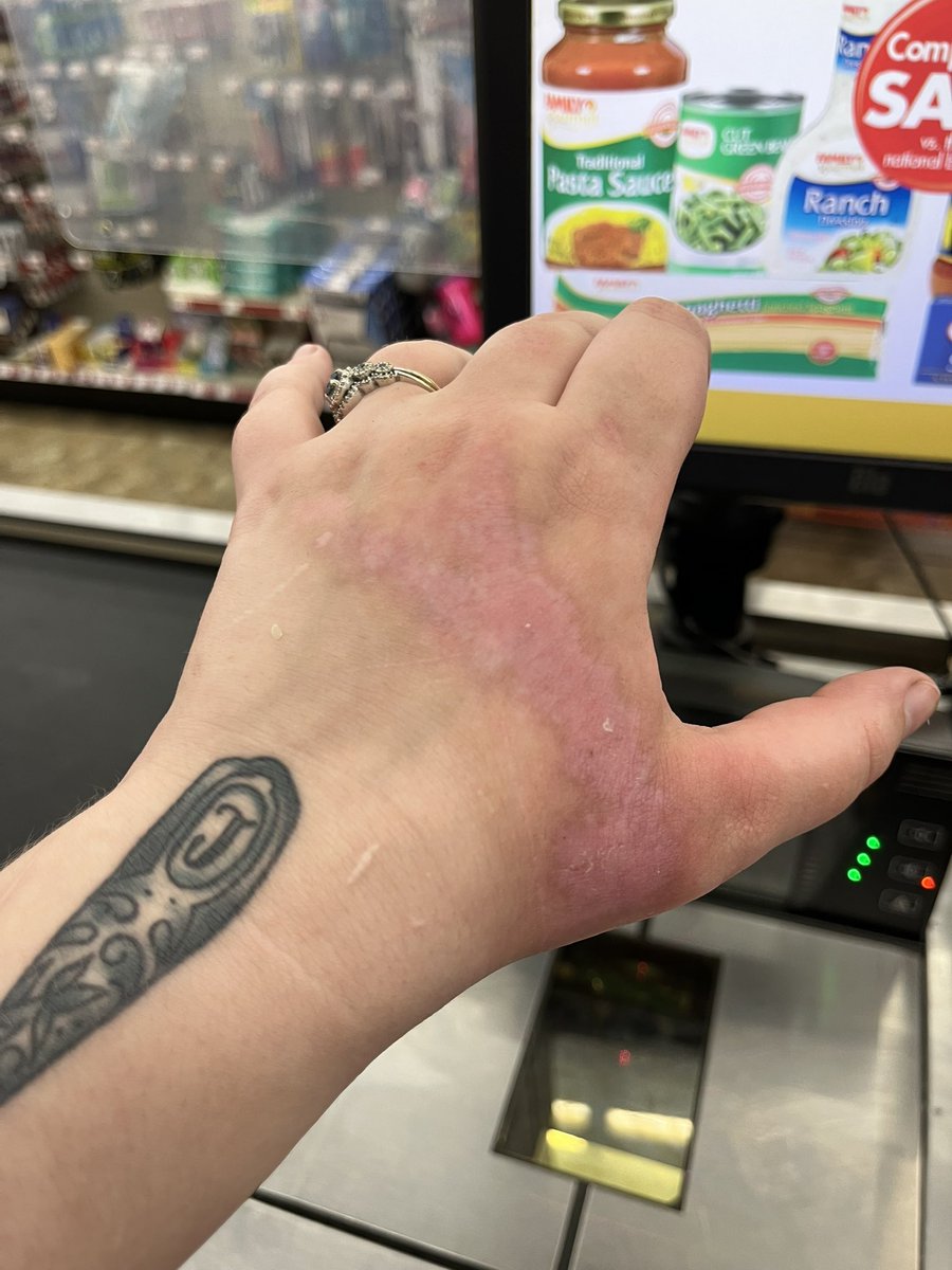 HeatherMerrie's tweet image. Well pretty much all healed, the scarred pretty much how I figured it would 😅