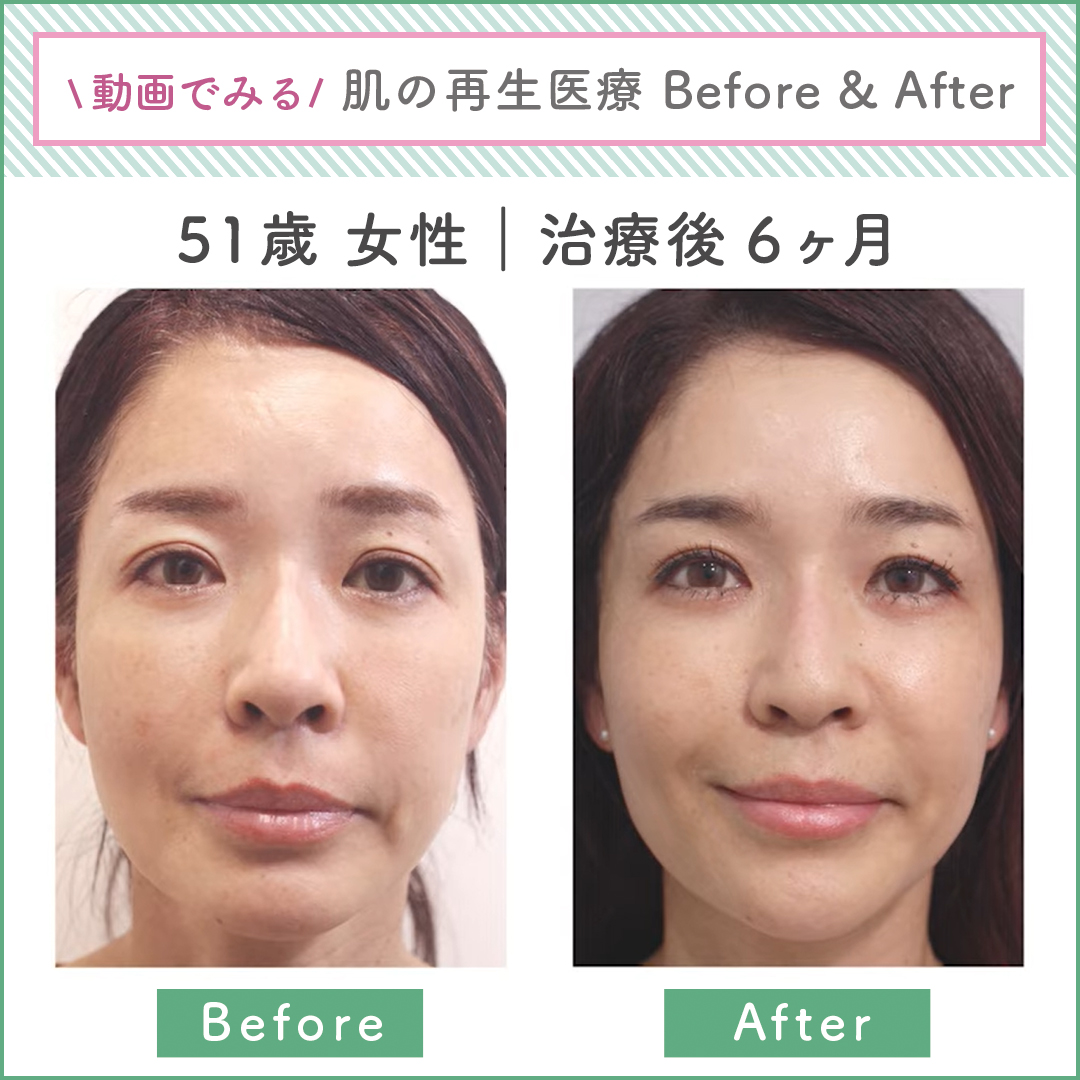 Rdクリニック 肌の再生医療専門 整形はしたくない でも若いままでいたい メスも異物も使わないアンチエイジング シワ や たるみ だけでなく お肌の状態の改善も見られます ビフォーアフター動画 T Co Wqdarq8esa 他の症例も公開中