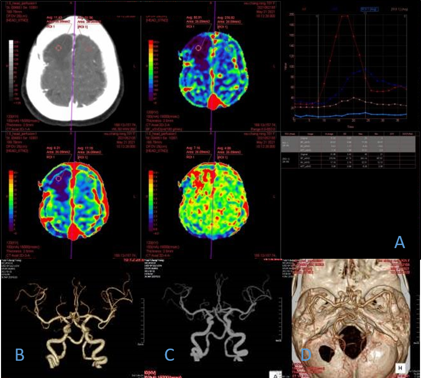 MinfoundMedical's tweet photo. The images below came from a 70-year-old female who has had diabetes for years. Right frontal hypoperfusion is seen in image A, and the cerebral artery is shown in images B, C, and D. https://t.co/DKFuWOXyYm