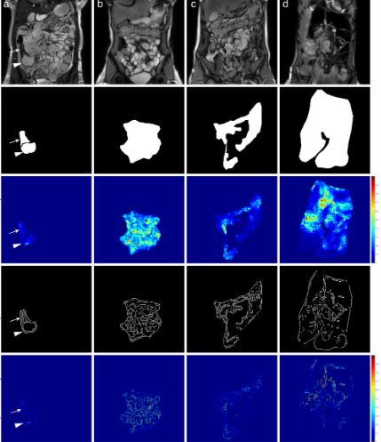 BJR_Radiology's tweet photo. Impact of bowel dilation on small bowel motility measurements with cine-MRI: assessment of two quantification techniques
https://t.co/nfqal2XC9S
#FOAMed #Radiology https://t.co/qO5ZPgEFwS