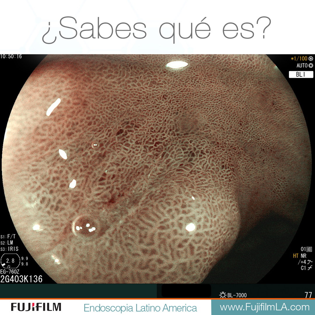 FujifilmLA's tweet photo. ¿Sabes qué es?
¿Puedes identificar lo que se observa y donde se encuentra?

#Cromoendoscopia #Eluxeo #EC760ZP #FujiFIlmEndoscopia #Endoscopia https://t.co/cuqfNGnyYJ