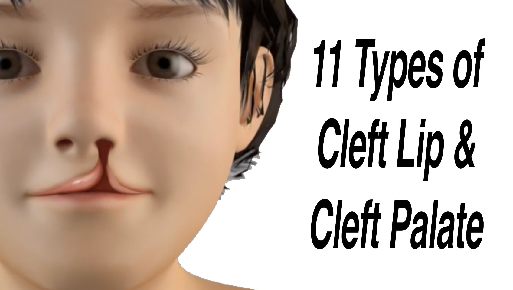 ENT Health ar Twitter "11 Types of Cleft Lip and Cleft Palate https