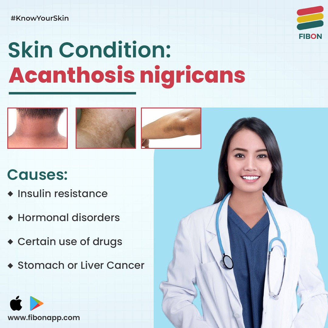 Fibonofficial's tweet photo. #AcanthosisNigricans is the name for dry dark patches of skin that usually appear in the armpits, neck and groins.

Are you worried if you might be facing such #skinproblems? Download Fibon!
 #YourPocketDermat and get your #skin conditions diagnosed today.
https://t.co/Y68wlQQcyN https://t.co/n0jZPZ0ea8