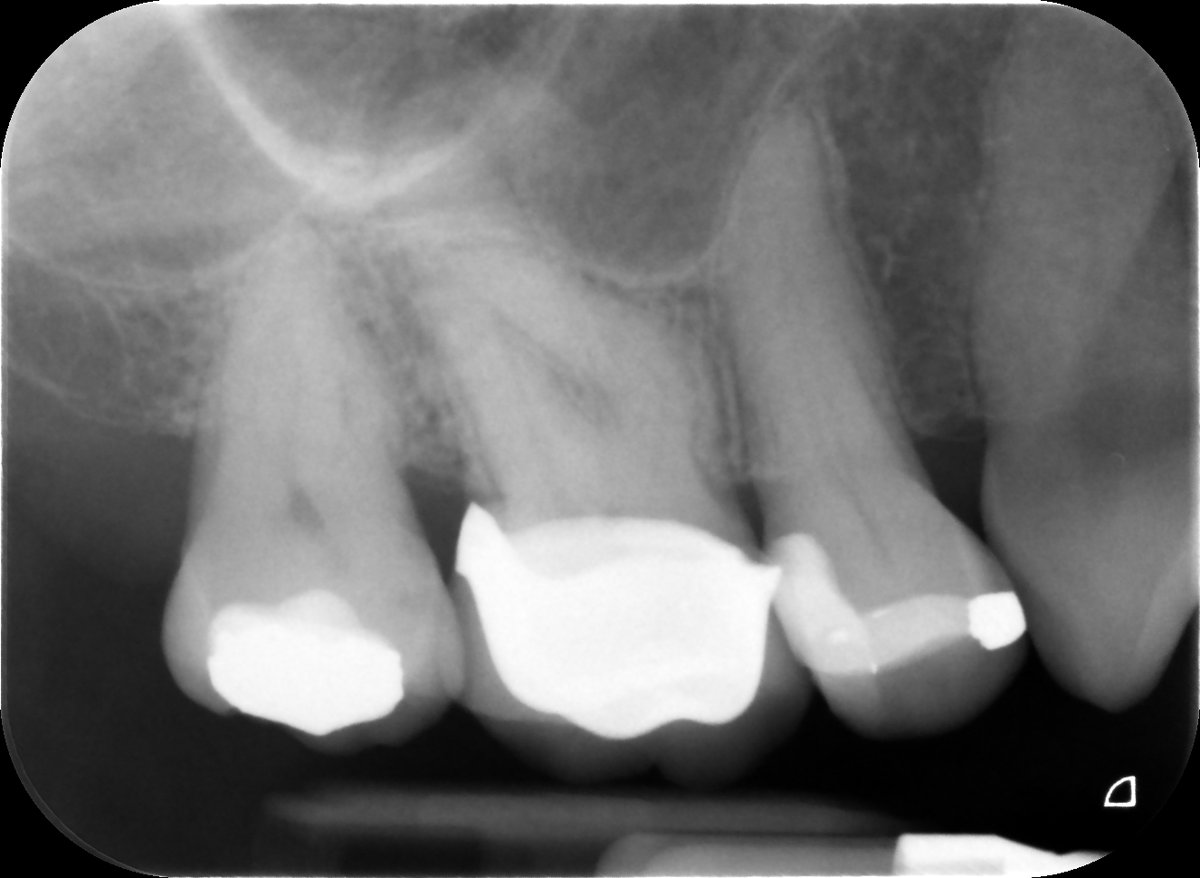 johnrhodesendo's tweet photo. Well that was fun!🤣 UR6 RCT always cautious when negotiating a dog-leg curvature in this case MB1 and MB2. High risk of file separation #savingteeth #endodontics https://t.co/epgXC7tep6