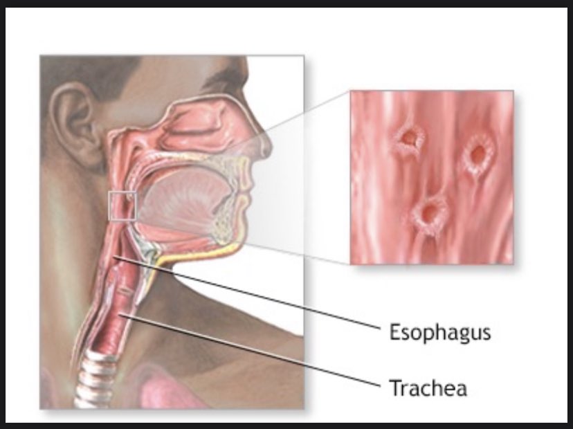 جدري القردة ينتشر الآن من مجتمعات المثليين في أوروبا وأمريكا الشمالية

هذا المرض موجود في وسط أفريقي...