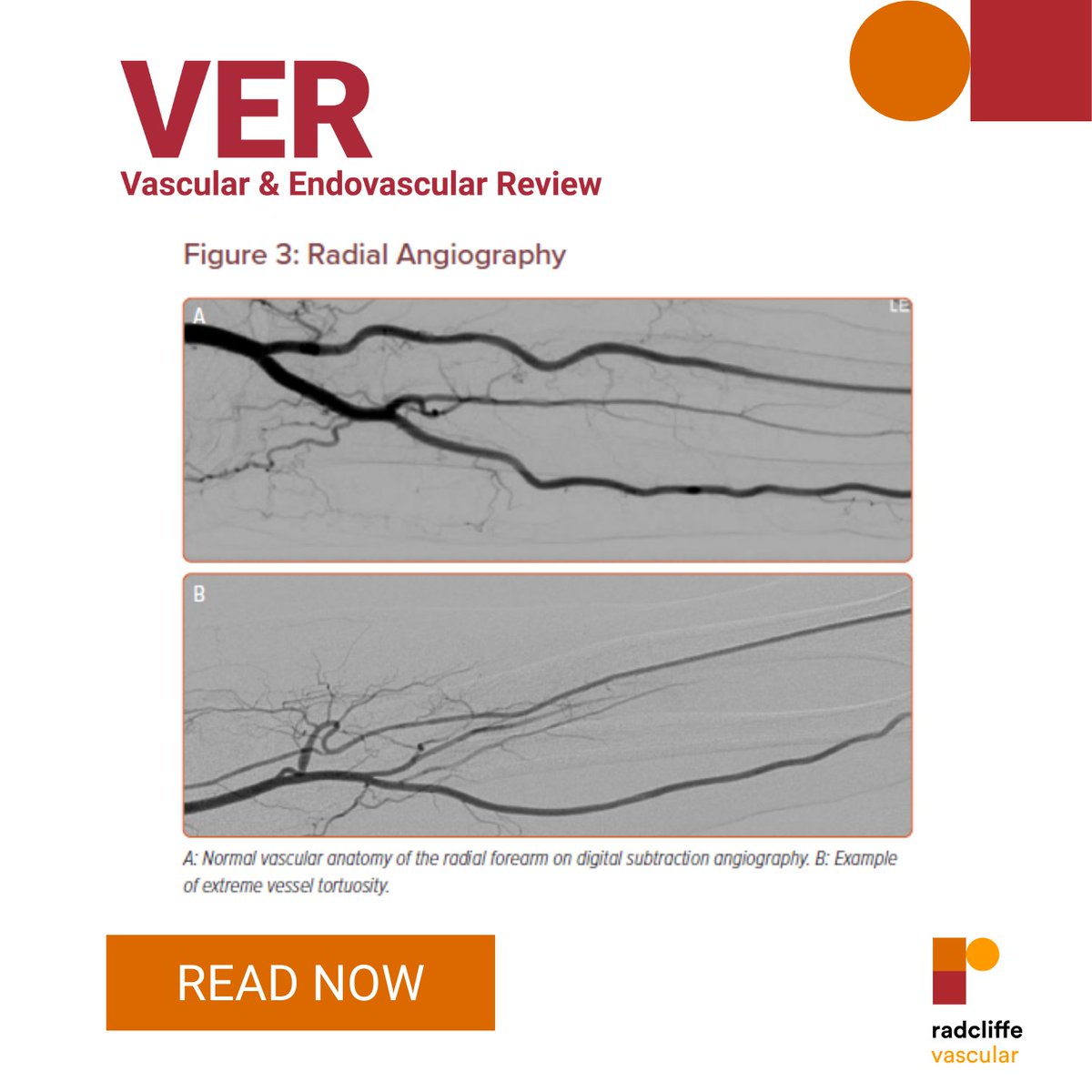 radcliffeVASCU's tweet image. Can Transradial Access provide a safer and more convenient experience for the patient? Read the article by Hobby et al. to find out 👉 ow.ly/O1Zm50JhFJj

@DrAndrewChoong @RKolluriMD @a_saratzis @kush_r_desai 
#CardioTwitter #MedEd #Epeeps