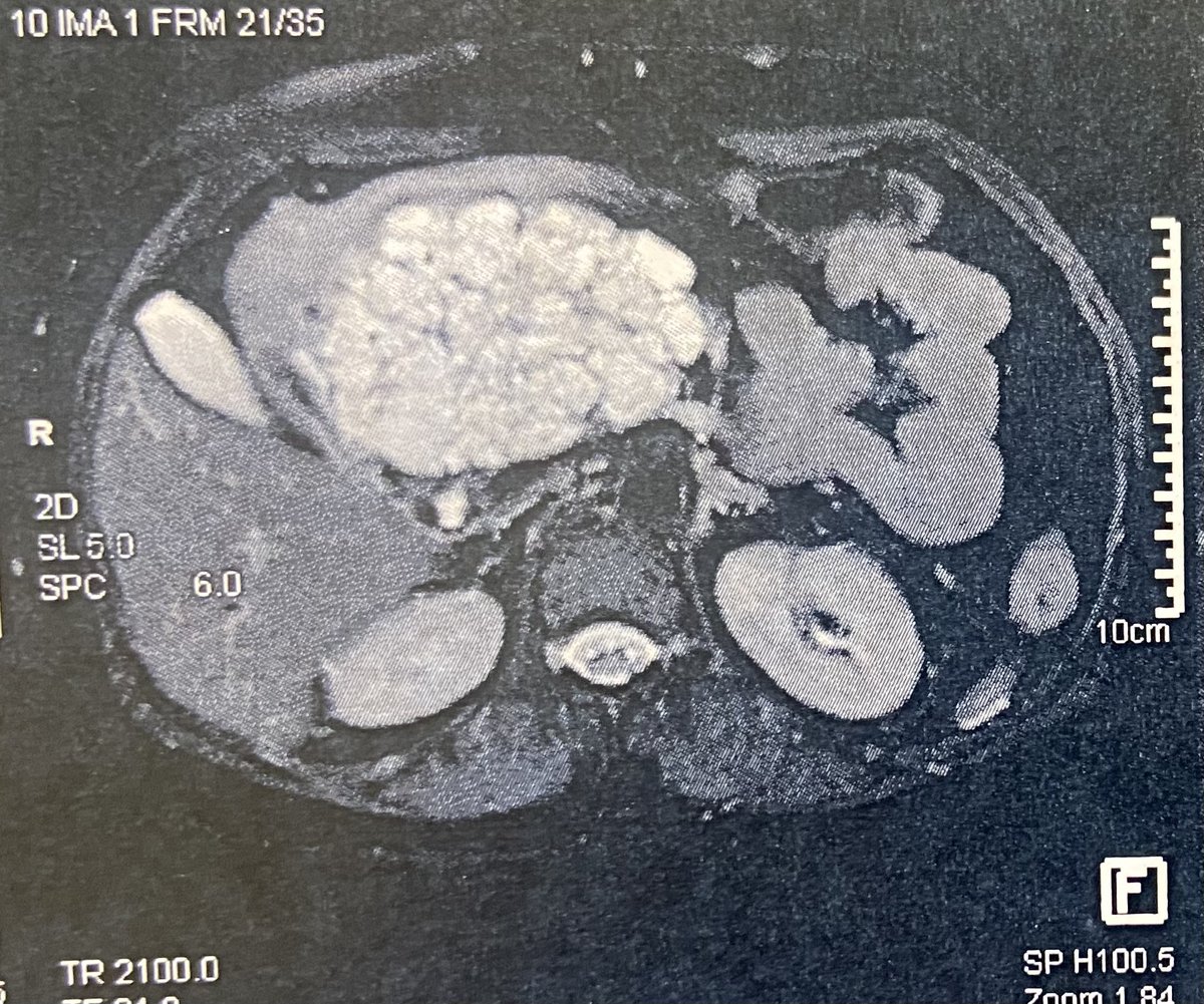 manishdoc2000's tweet photo. Giant serous cystadenoma of head of pancreas (10.5 x 7cm), no symptoms, distal pancreas atrophy. 
Treatment : observation vs surgery @IHPBA @YouppiePancreas https://t.co/N50z0JvDIX