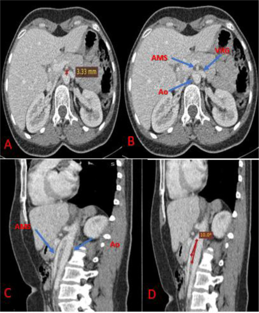 The Nutcracker Syndrome is a rare and often unrecognized cause of chronic pelvic pain and left back/flank pain.

The commonest symptom is haematuria (blood in the urine) & the next most prevalent symptom is flank pain. 

ow.ly/Hht550JeRIu

#renalpain #flankpain