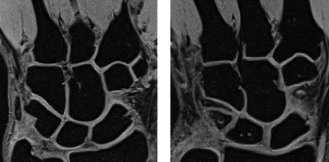 CNHC_research's tweet photo. QUIZ: #kienbocksdisease surgery includes #proximalrowcarpectomy or #lunatereconstruction with a #medialfemoraltrochlea #osteochondral flap. We found the MFT flap was closer in shape to the #proximallunate, but can you guess what other options fit well? https://t.co/WpXIRwFd1m https://t.co/nOTYQUVH6a