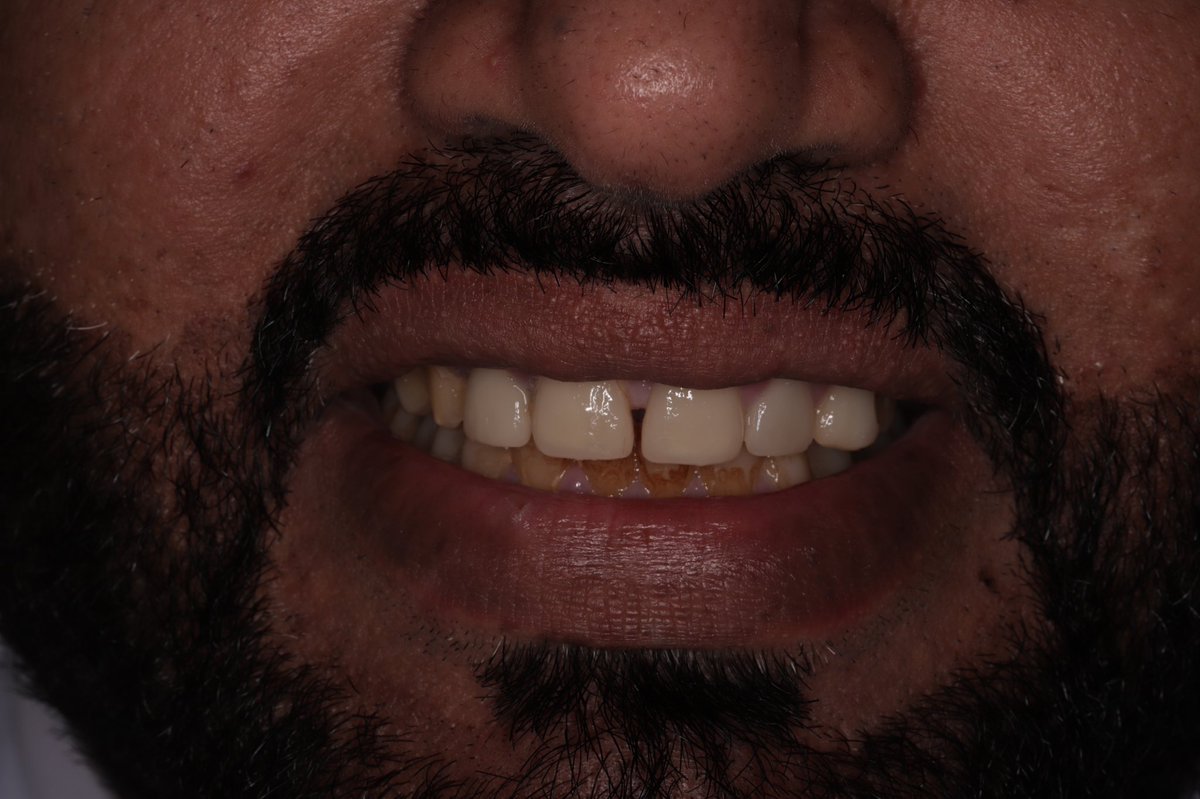UrAdham's tweet photo. مراجع يشتكي من فلجة بين الأسنان الأماميه وعدم تناسق شكل الأسنان ولونها، مع العلم انه خضع لعلاج سابق في احدى العيادات الخاصه.
بعد الكشف تم وضع الخطة العلاجية المناسبة. 
وتم علاج الحالة ب ٤ عدسات فينير و تلبيستين E-max للأنياب ، واقفال الفلجة بين الأسنان حسب رغبة المريض 💎✨ https://t.co/idQKhE6a3o
