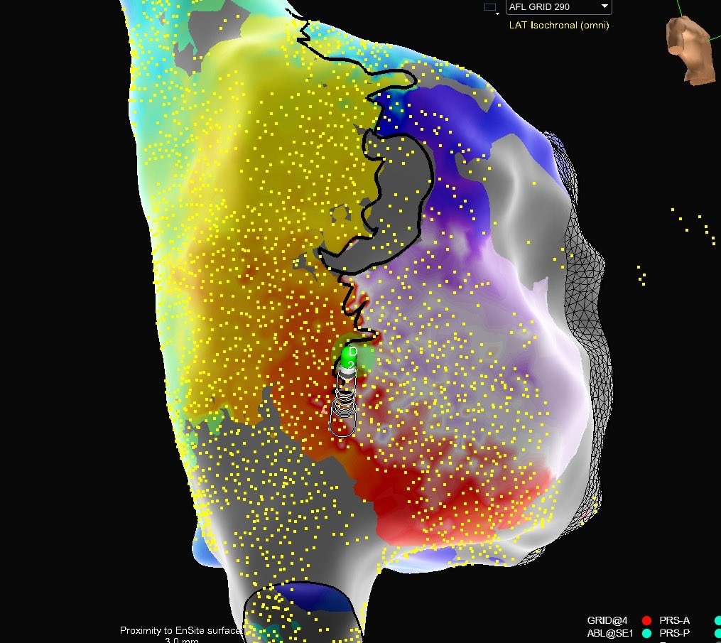 A slight extension in cycle length hinted that this was no longer typical AFL… Following CTI ablation, #HDGrid revealed an atypical flutter rotating around cannulation scar 🔄 Mapped and ablated by @DaktariJay with #EnSiteX via Voxel mode. #OnlyWithOT #EPeeps @AbbottCardio
