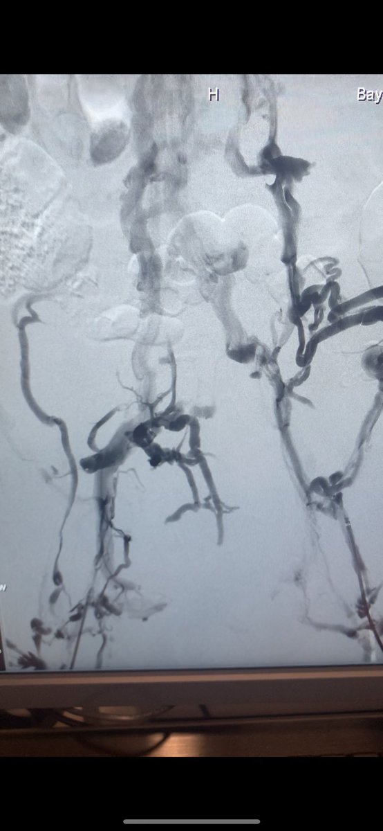 joeliechty's tweet photo. 55 y/o male with bilateral post-thrombotic syndrome… did not expect him to require as extensive of a reconstruction as he did! https://t.co/qTCQV1H8Ql