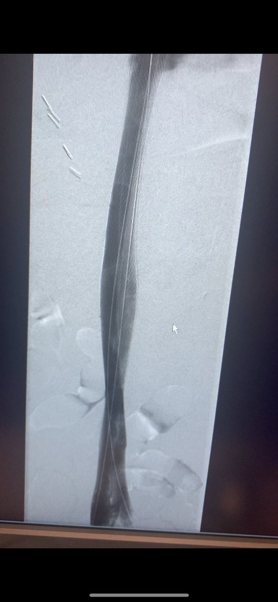 joeliechty's tweet photo. 55 y/o male with bilateral post-thrombotic syndrome… did not expect him to require as extensive of a reconstruction as he did! https://t.co/qTCQV1H8Ql