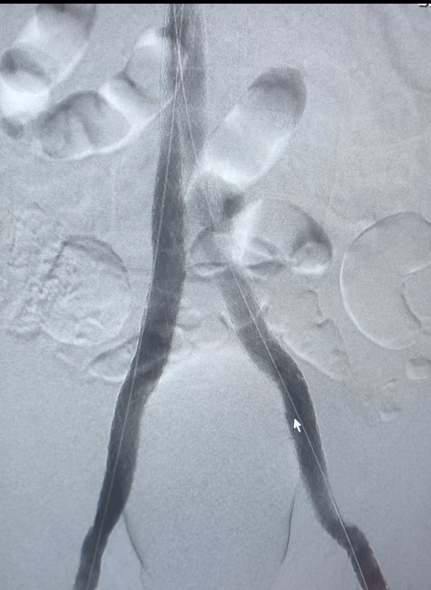 joeliechty's tweet photo. 55 y/o male with bilateral post-thrombotic syndrome… did not expect him to require as extensive of a reconstruction as he did! https://t.co/qTCQV1H8Ql