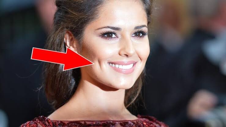 9Injections's tweet image. Les #fossettes sont un défaut génétique héréditaire.Le responsable est le grand #zygomatique un muscle du visage qui relie la pommette à la commissure des #lèvres et s&apos;active notamment lorsque l&apos;on #sourit. si le grand zygomatique est court deux petits #creux_mignons se forment.