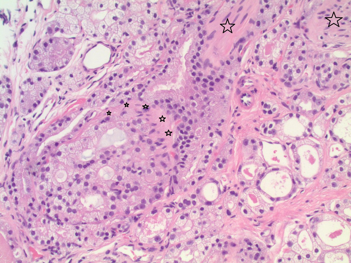 slusagar's tweet photo. #GUpath #grayzonepath:
prostate bx with cancer, conceivably elements of pattern 4 with +/- cribriform formation, but lower power 🔬shots show cancer focus effectively centered around an incoming nerve... https://t.co/IF16SzloQV