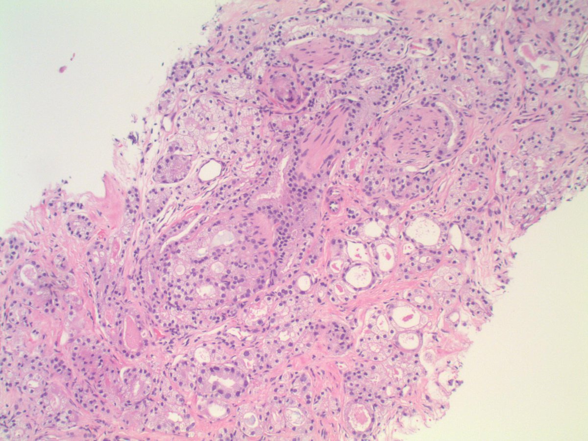 slusagar's tweet photo. #GUpath #grayzonepath:
prostate bx with cancer, conceivably elements of pattern 4 with +/- cribriform formation, but lower power 🔬shots show cancer focus effectively centered around an incoming nerve... https://t.co/IF16SzloQV