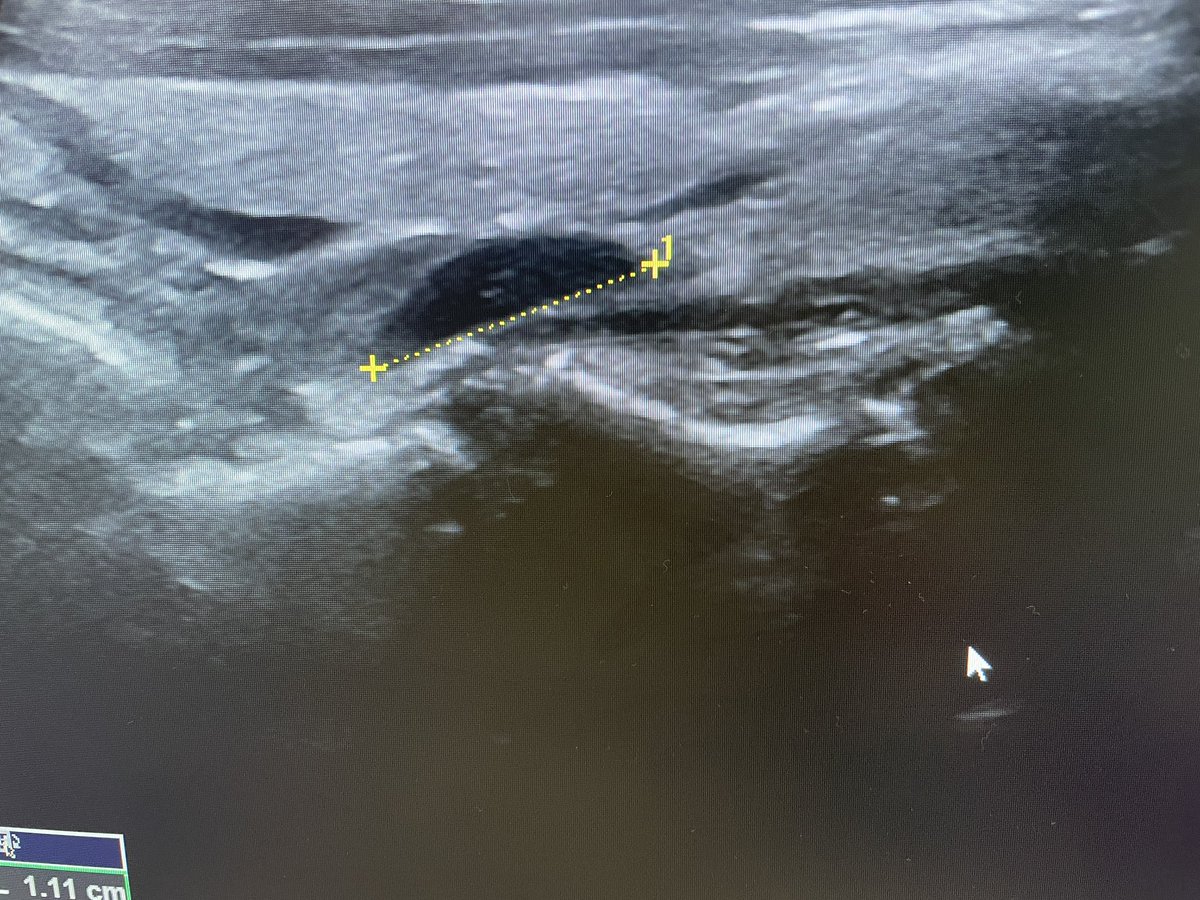WilliamRBlythe's tweet photo. Axial & Saggital view of parathyroid adenoma on US, and on back table. 15 min focused parathyroidectomy. PTH 135 -> 32 in PACU.
#ENTwitter #Photolaryngology #GeneralENT https://t.co/jzmsO5TQg4